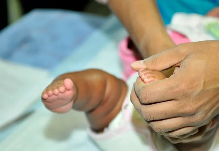 South Africa's Push for Equitable Clubfoot Treatment Amidst Geographic Hurdles